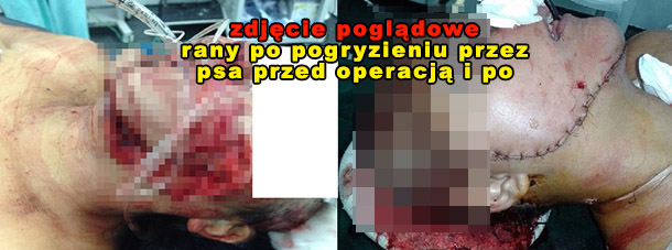 Stan 6-latka ciężki, ale stabilny. Zobacz charakter ran