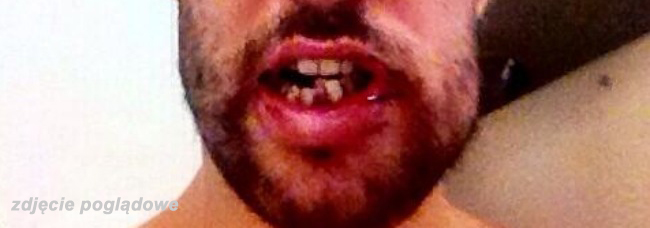 Złamał szczękę na dyskotece