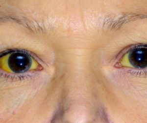 Trzy nowe osoby z żółtaczką (m.in. 5-letnie dziecko)