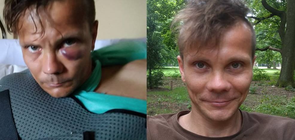 Po imprezie ktoś złamał mu rękę w 3 miejscach