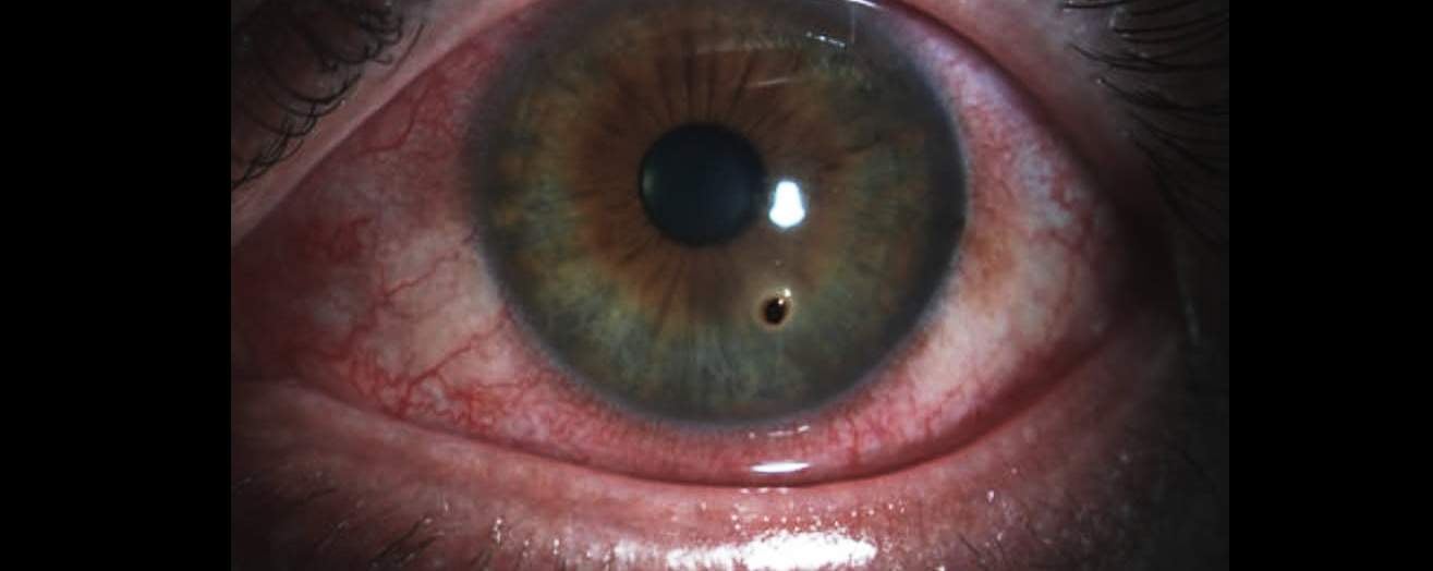 Miał opiłek w oku. Odmówili mu pomocy